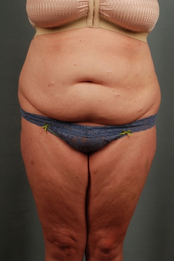 Plus Size Tummy Tuck: High BMI Tummy Tuck